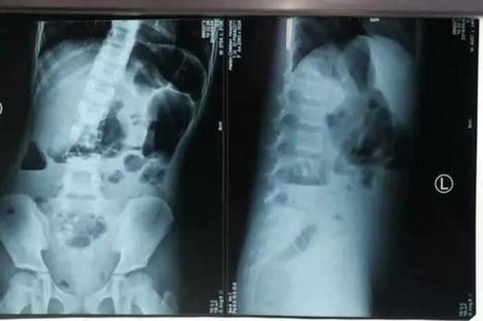 Hasil scan medis menunjukkan teratoma di dalam perut gadis tersebut