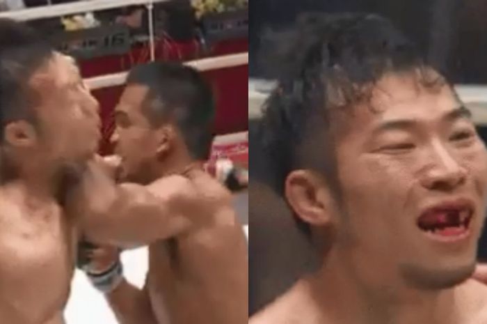Petarung MMA asal Jepang, Yusaku Nakamura, kehilangan dua gigi setelah mendapat sikutan dari Thanongaklek Chuwattana.