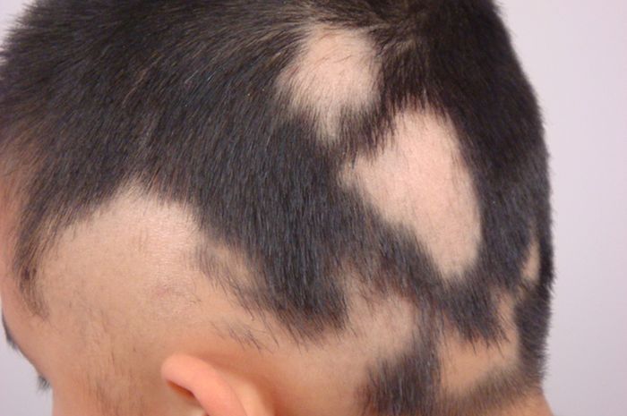 Alopecia areata pada anak