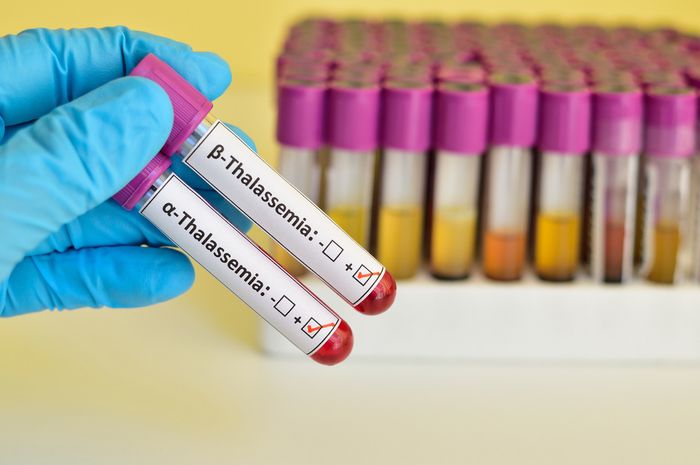 Ketahui Talasemia Penyakit Kelainan Darah Yang Tak Bisa Dicegah Dan Disembuhkan Semua Halaman Grid Health