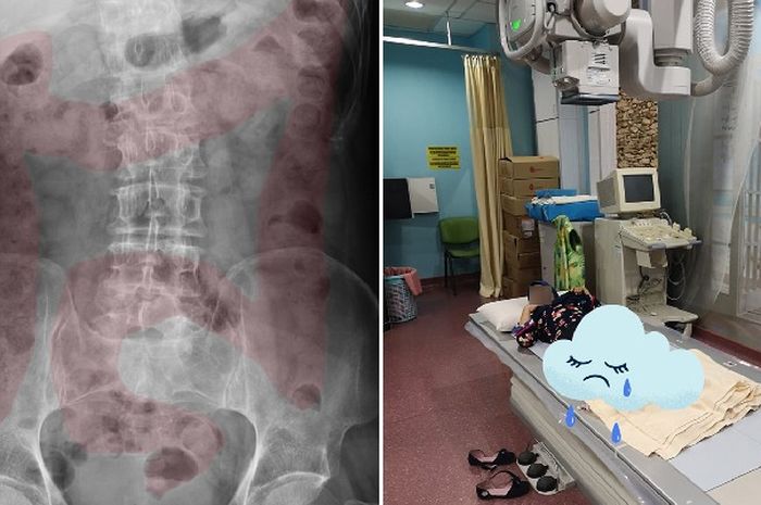 Hasil Rotgen gadis yang tak pernah makan sayuran
