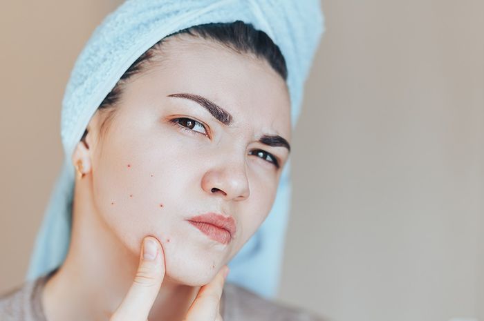 Nggak Perlu Repot ke Klinik Kecantikan, Hilangkan Noda Bekas Jerawat di