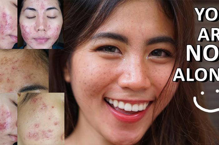 Cerita Daripada Influencer Yang Mengalami Jerawat Terburuk