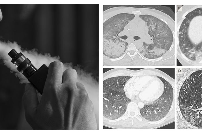 Ngeri! 3 Orang Meninggal Dunia Usai Terkena Pemyakit Paru-paru Secara Misterius Setelah Menggunakan Vape!