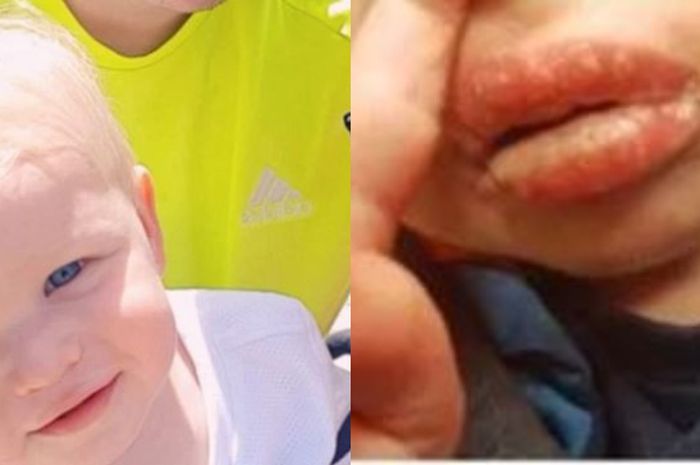 Seorang bayi di Wales Australia terjangkit penyakit herpes hingga menyebabkan bibirnya melepuh dan mengeluarkan cairan hingga nyaris meninggal