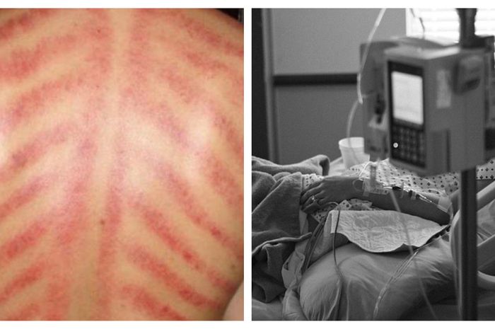 pria mendadak stroke akut setelah menjalani pijat dan kerokan