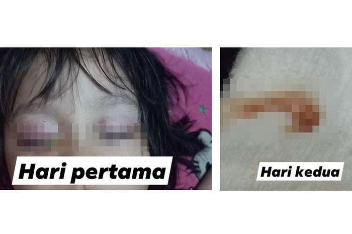 Viral Mata Anak Ini Keluarkan Cairan Mirip Nanah Diduga Karena Radiasi
