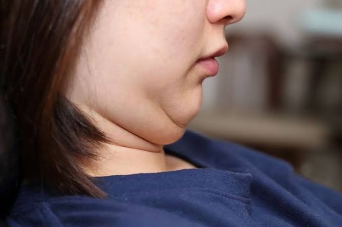 Selain Mengganggu Penampilan Double Chin Ternyata Juga Bisa