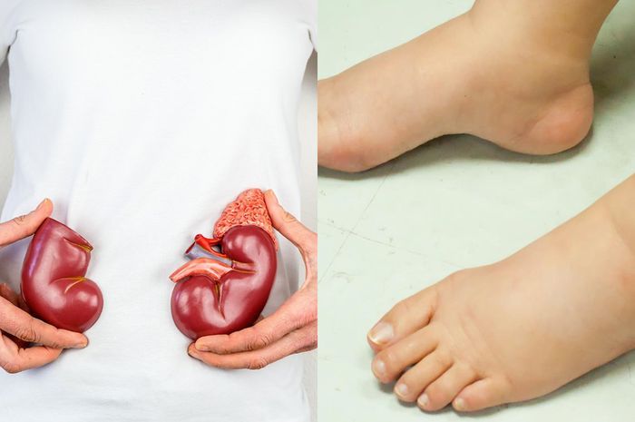 Jangan Sepelekan Bengkak Pada Kaki Karena Bisa Jadi Pertanda Gagal