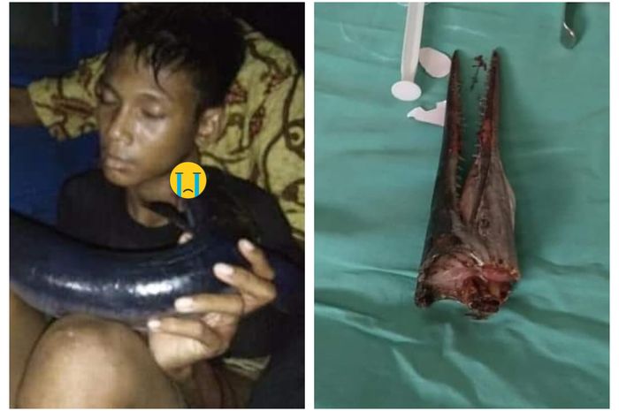Lagi Asik Mancing, Anak ini Malah Diserang Ikan Hingga Tertusuk di Leher, Begini Kronologinya...