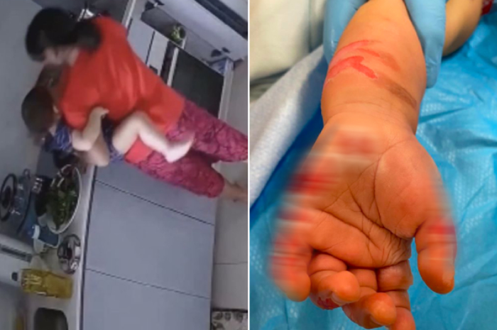 Pembantu memaksa balita mencelupkan tangan ke panci berisi air mendidih.