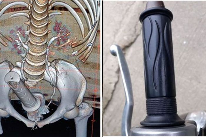 Awalnya Sakit Perut, Dokter Ternyata Temukan Stang Motor di Dalam Rahim, Wanita Ini Terancam!