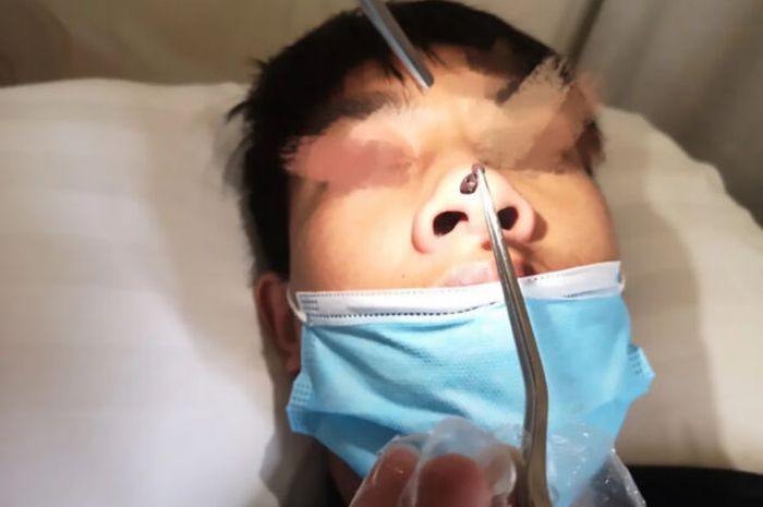 Sering Terasa Gatal Dokter Temukan Makhluk Penghisap Darah Di Hidung Bocah Ini Semua Halaman Hai
