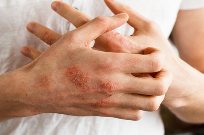 Ilustrasi penyakit herpes pada kulit