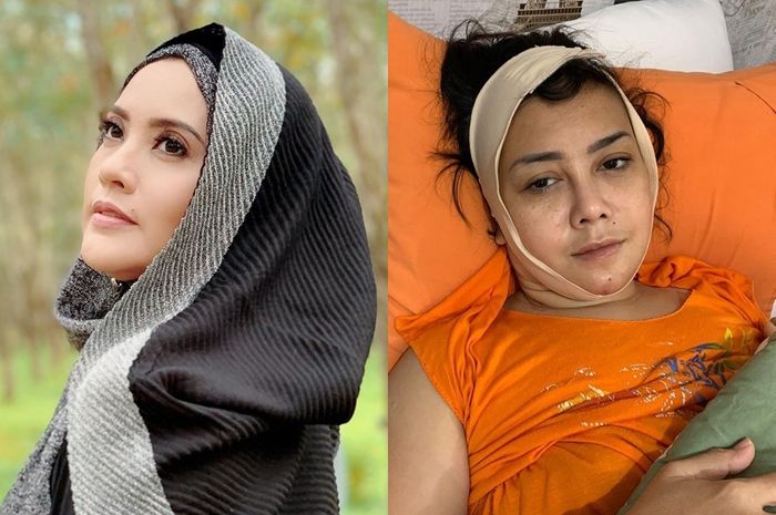 Kakak Elma Theana, Rency Milano diduga jadi korban malapraktik klinik kecantikan