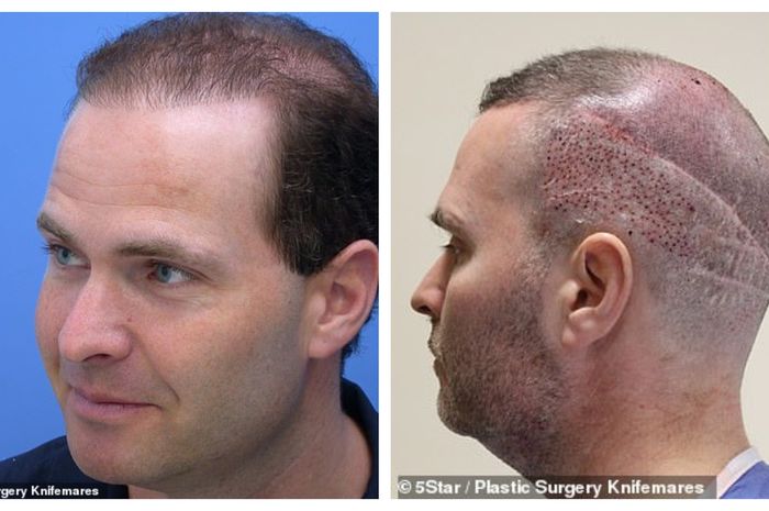 Pernikahan Pria Ini Hancur karena Terobsesi dengan Transplantasi Rambut