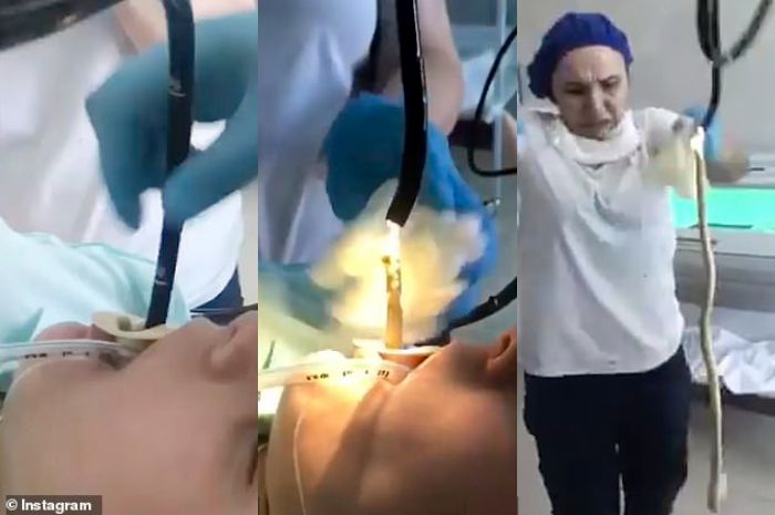 Detik-detik Dokter Keluarkan Ular Sepanjang 1,2 Meter dari Mulut Seorang  Wanita Gegerkan Jagad Maya, Diduga sang Hewan Reptil Melata Masuk ke Dalam  Tubuh Saat Pasien Tertidur Lelap - Semua Halaman - Sosok