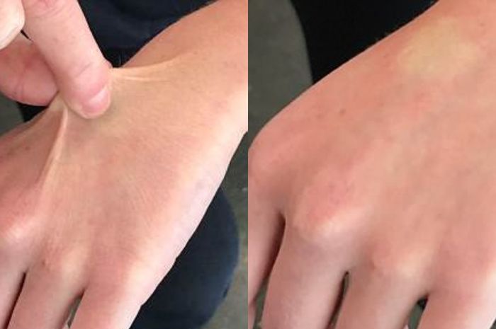 Cubit Tangan Bisa Tunjukkan Tubuh Dehidrasi Atau Enggak Kok Bisa Semua Halaman Cewekbanget