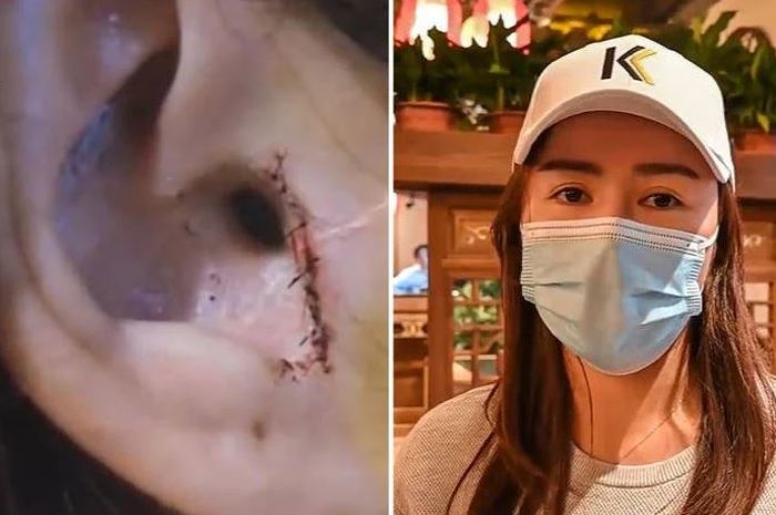 Zhao, wanita muda di China yang operasi hidung justru kehilangan bagian telinganya