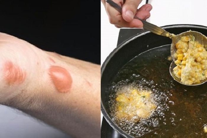 Jadi Luka Permanen Jika Dibiarkan Begini Cara Obati Luka Kulit Akibat Percikan Minyak Panas Dengan Bahan Dapur Semua Halaman Sajian Sedap