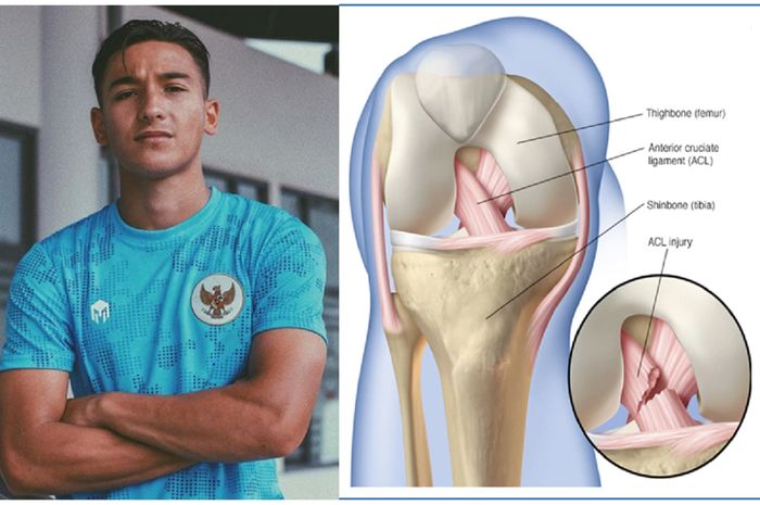Striker Timnas U-19 Indonesia Jack Brown cedera anterior cruciate ligament (ACL) saat latihan di Jakarta. Gambar kanan memperlihatkan posisi ACL.