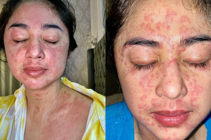 Serupa Gejala Positif Covid-19 yang Dialami Dewi Perssik