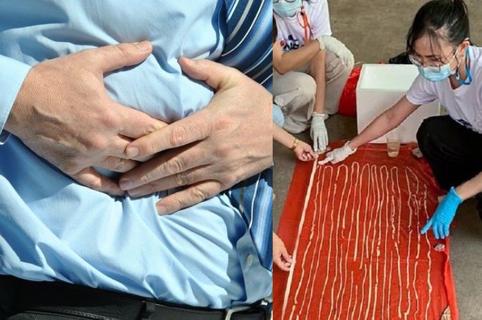 Mengeluh Ada yang Tak Beres di Perutnya, Dokter yang Memeriksa Sampai Terkejut Saat Benda Sepanjang 17 Meter Keluar dari Pantat Pria Ini
