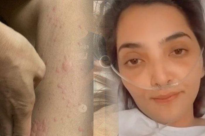 Ashanty kembali alami autoimun jelang pernikahan Atta Halilintar dan Aurel Hermansyah
