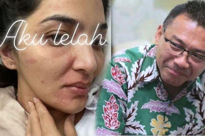 Bak Petir Menyambar, Ashanty Terancam Lumpuh? Artis Ini Jadi Contoh Pernah Tak Bisa Bergerak Gegara Alami Penyakit Sama Seperti Istri Anang Hermansyah