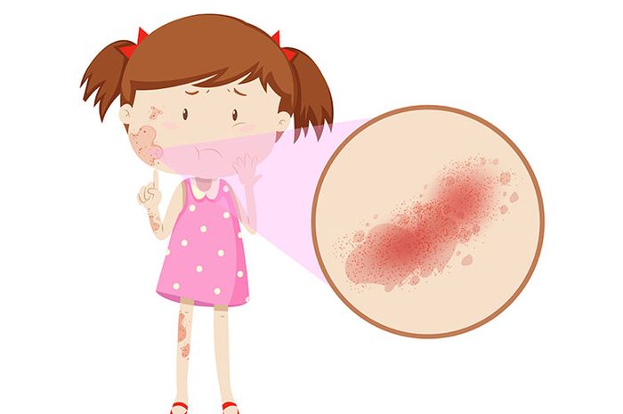 Apa Itu Flu Singapura? Ini Risiko Penularan, Gejala, dan Pengobatannya