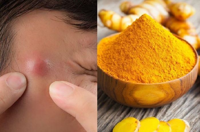 Percuma Pakai Salep Terus Terusan Mending Oles Dengan Makanan Untuk Obat Hilangkan Bisul Ini Di Malam Hari Jangan Kaget Bangun Tidur Jadi Begini Semua Halaman Sajian Sedap
