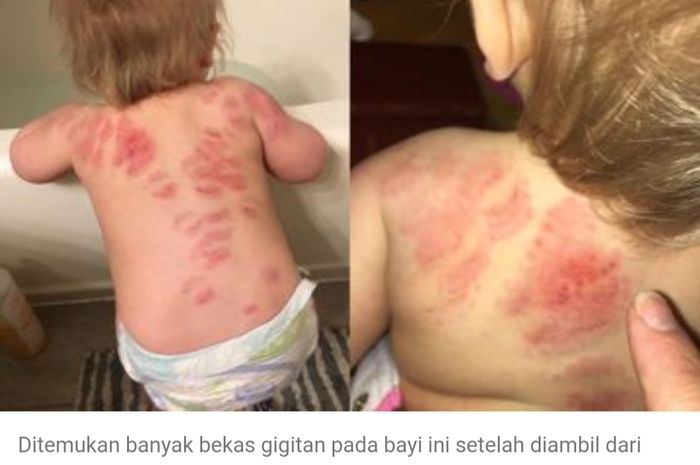 Seorang Ibu Temukan Lebih dari 25 Bekas Gigitan di Tubuh Putrinya Usai Dijemput dari Penitipan Anak.
