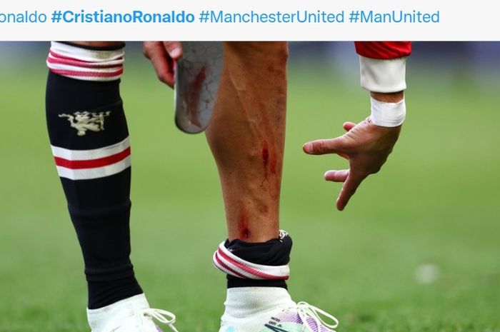 Cristiano Ronaldo mengalami luka cukup parah di kaki kirinya saat laga melawan Everton, Sabtu, (9/4/2022).