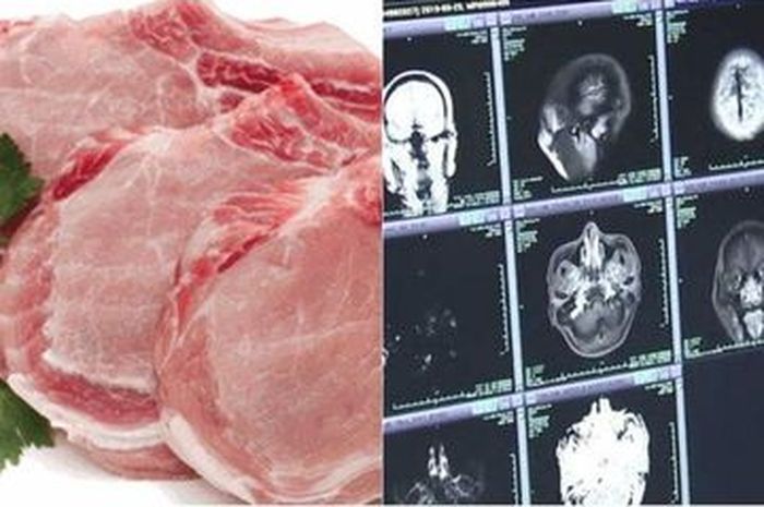 Merinding Banget! Remaja Ini Tewas Setelah Otaknya Digerogoti Cacing