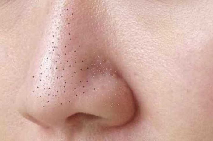 Selamat Tinggal Hidung Landak, Komedo Hilang dengan 5 Bahan Alami Ini