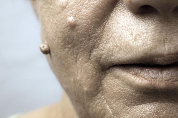 5 Cara Alami Menghilangkan Kutil di Wajah, Pakai Kentang Hingga Nanas