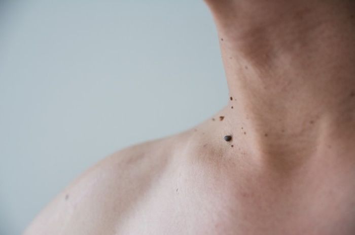 6 Jenis Kutil yang Tumbuh di Kulit, Ada yang Nyeri Hingga Bikin Risih