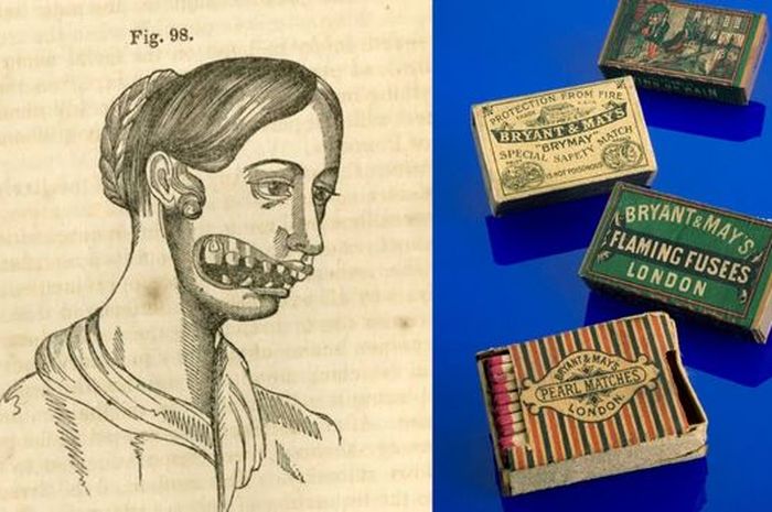 Kisah Pilu Para Gadis Korek Api yang Rahangnya Busuk karena Uap Fosfor ...