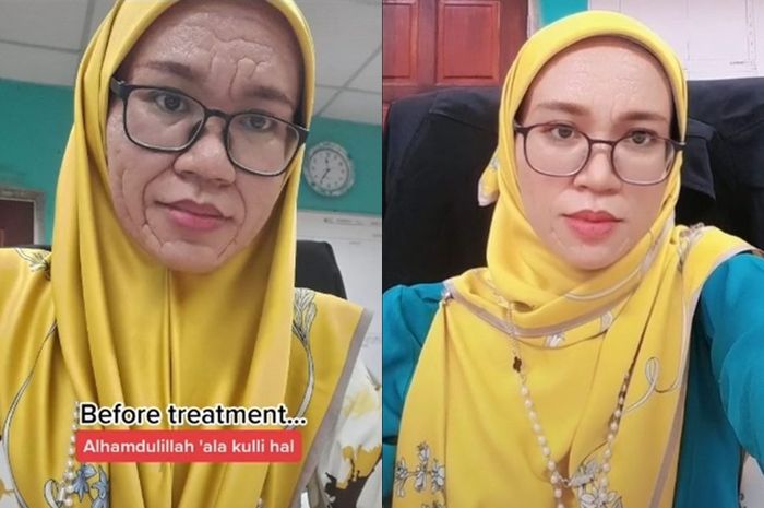 Wajah Lyna Sabran yang menua setelah melahirkan karena alami kelainan kulit langka
