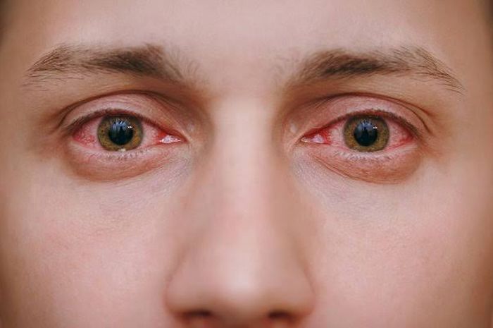 ¿Se puede ver?  Por este método resulta que la enfermedad de los ojos rojos es contagiosa