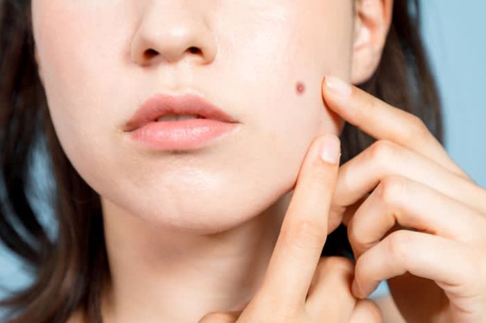 Bukan Sulap Bukan Sihir, Tahi Lalat di Pipi Bisa Hilang Tanpa Operasi