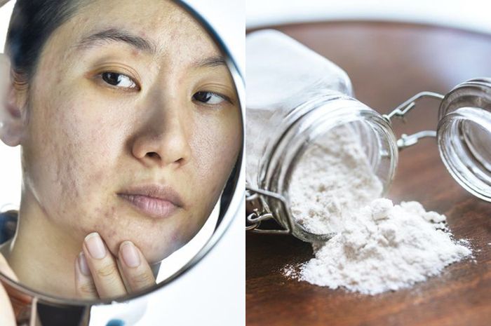 Cara Menghilangkan Bopeng Di Wajah Secara Alami Cara Menghilangkan Bopeng di Wajah dengan Baking Soda, Cukup Dipakai