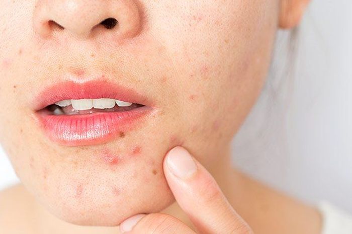 Pocas veces percibido, el acné en la cara tiene diferentes significados según su ubicación