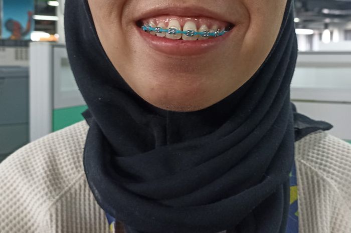 Biaya Pasang Behel di Puskesmas dan Rumah Sakit Pakai BPJS Bisa? Nakita