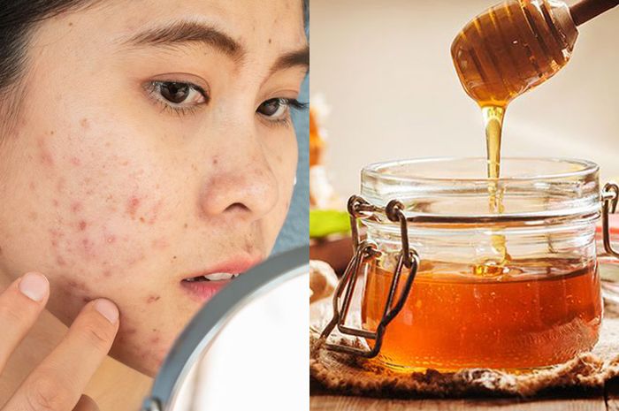 Cara Menghilangkan Bopeng Di Wajah Secara Alami Aneka Tips Kecantikan, Begini Cara Menghilangkan Bopeng Bekas Jerawat