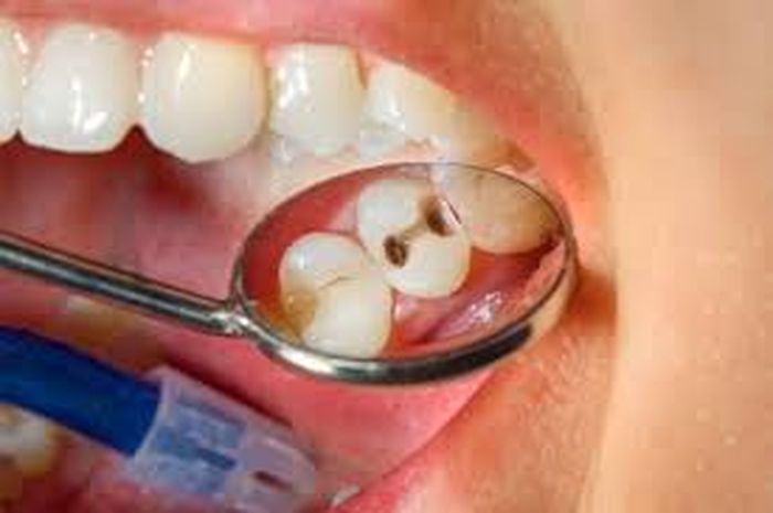 Ada Cara Efektif Mengatasi Gigi berlubang, Lebih baik dari Tambal Gigi? -  Semua Halaman - Grid Health