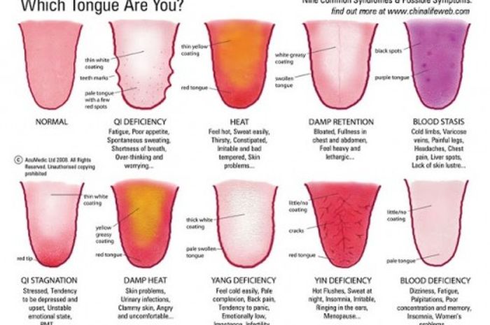 Aneka Warna Lidah yang Wajib Diketahui, Deteksi Penyakit dan Kondisi