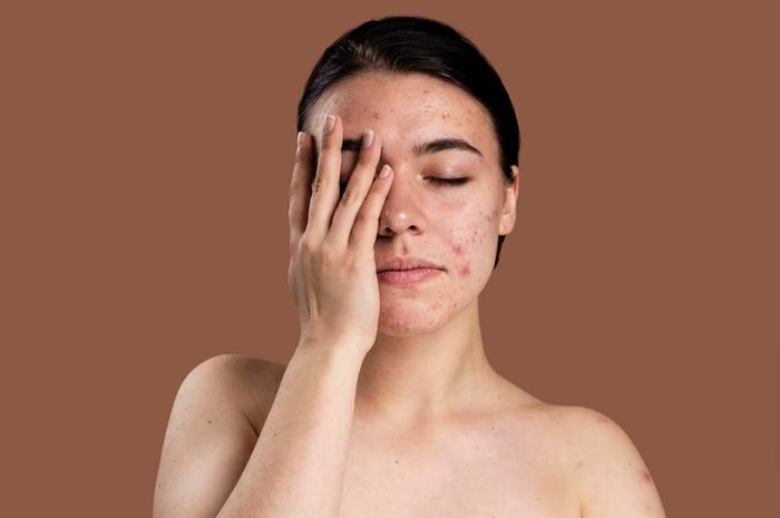 Cara Alami Menghilangkan Bekas Jerawat di Pipi, Manfaatkan Bahan Dapur