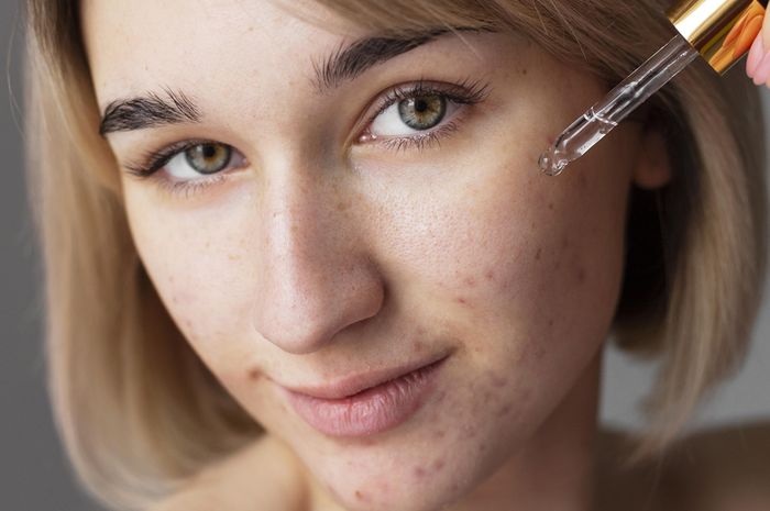 Apakah Vitamin C Bagus untuk Kulit Berjerawat? Ternyata Ini Manfaatnya