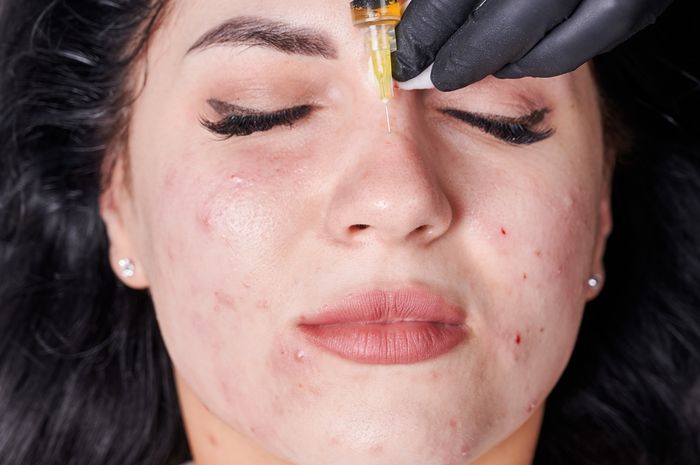 4 Pilihan Treatment Menghilangkan Bekas Jerawat di Klinik Kecantikan